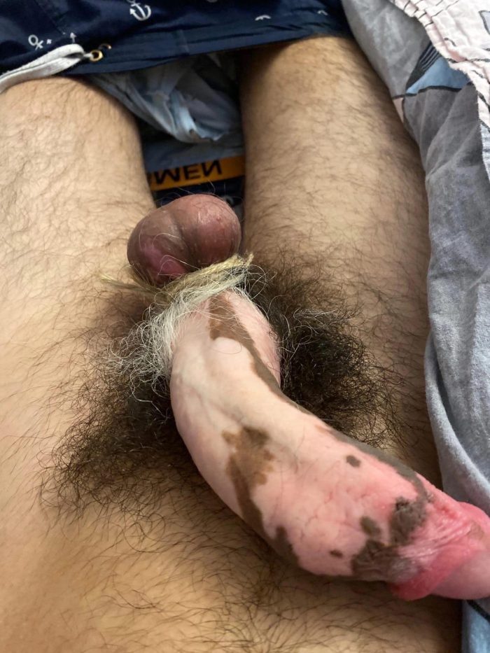Do you like my vitiligo stained cock balls and pubes? I only have it on my genitals.