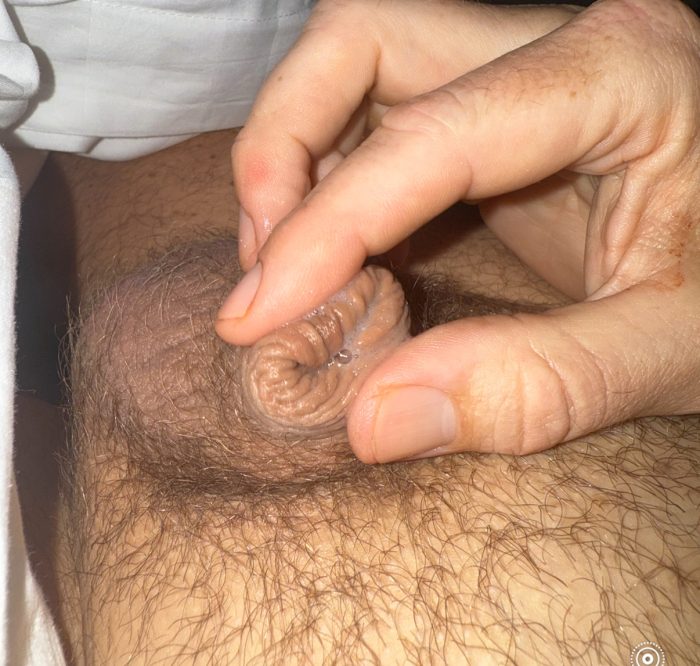 Tiny micro penis